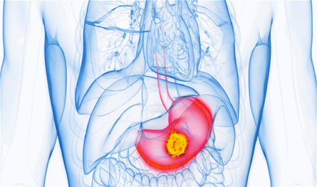 الكشف عن المراحل المبكرة وسبب جديد محتمل لسرطان المعدة
