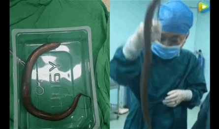 ثعبان بحر داخل جسد إنسان... حالة طبية نادرة تصدم الأطباء